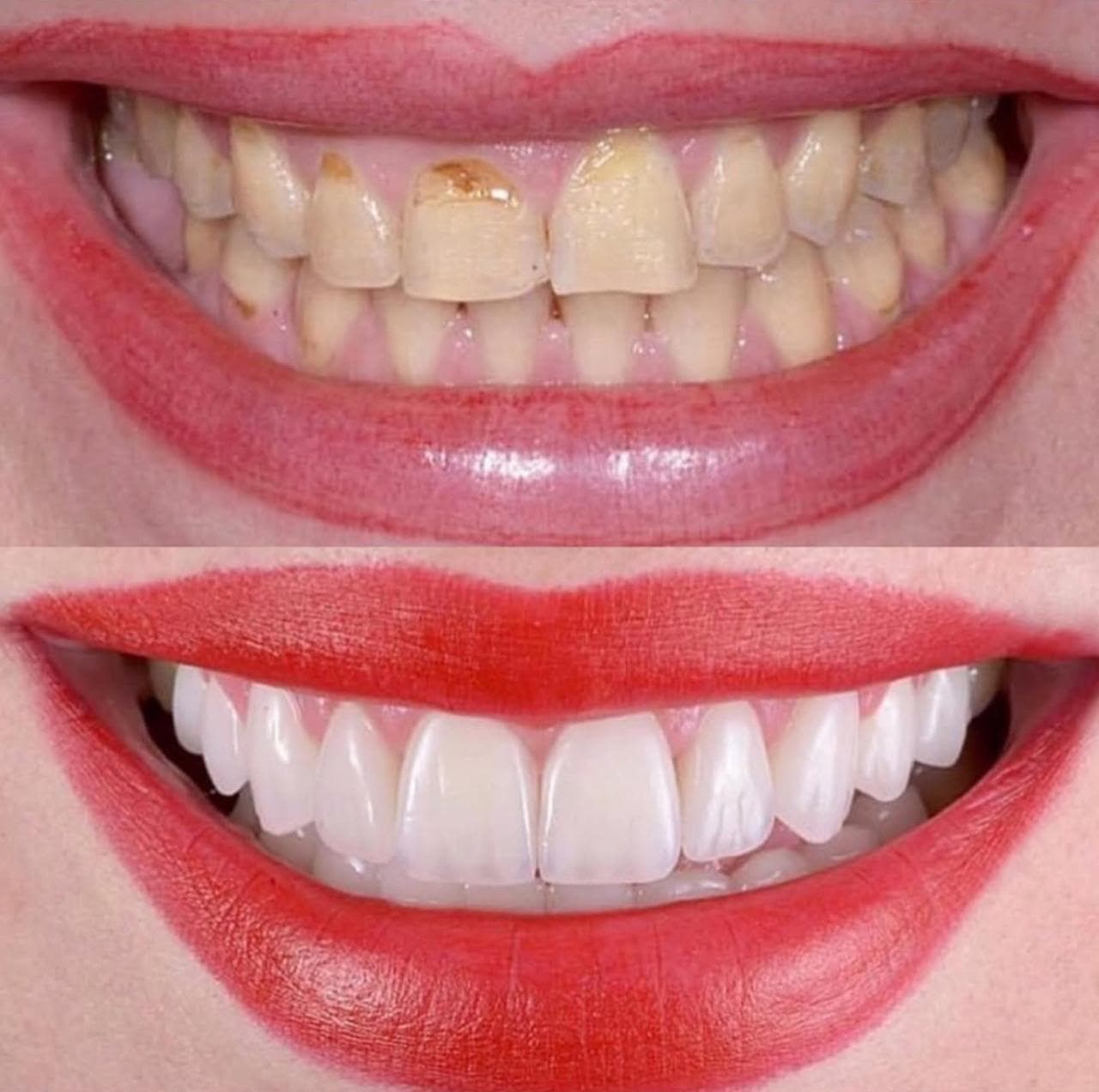 Resultado: lentes de porcelana — antes e depois