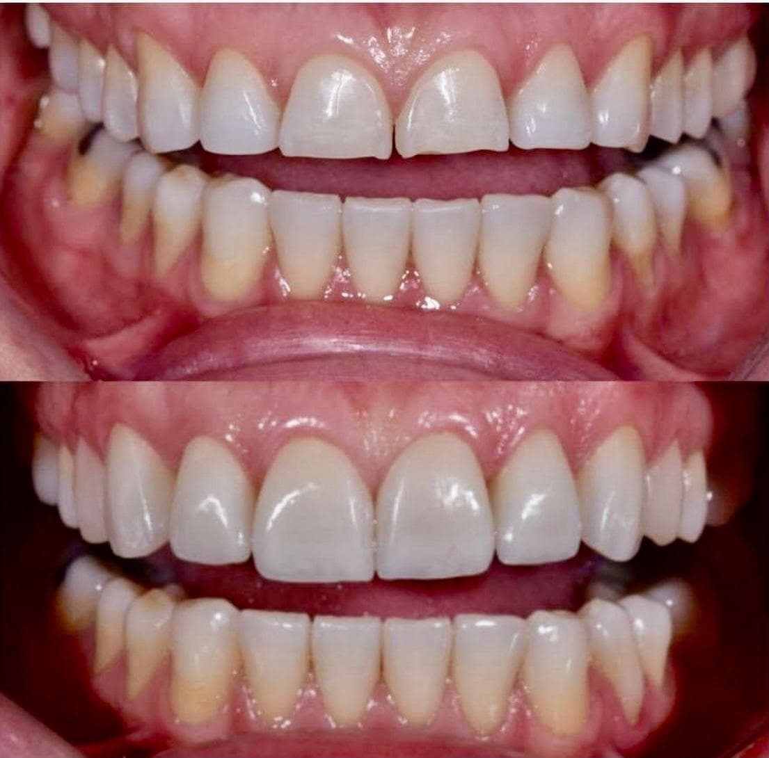 Resultado: lentes de porcelana — antes e depois