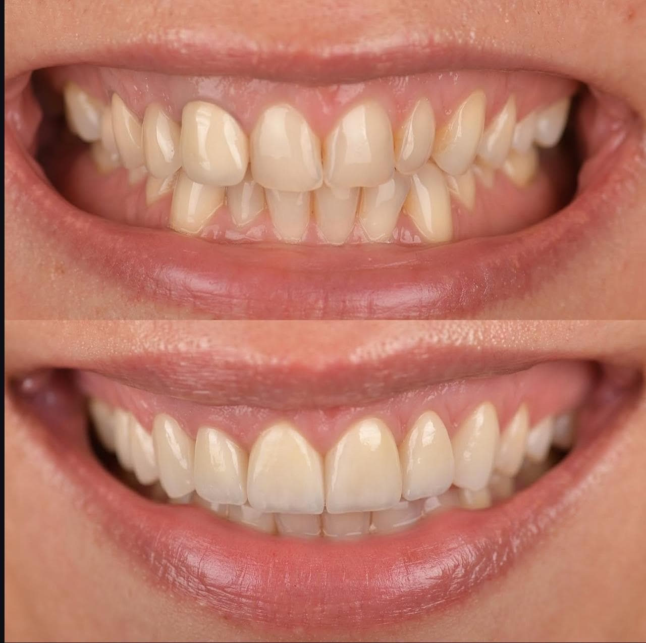 Resultado: lentes de porcelana — antes e depois