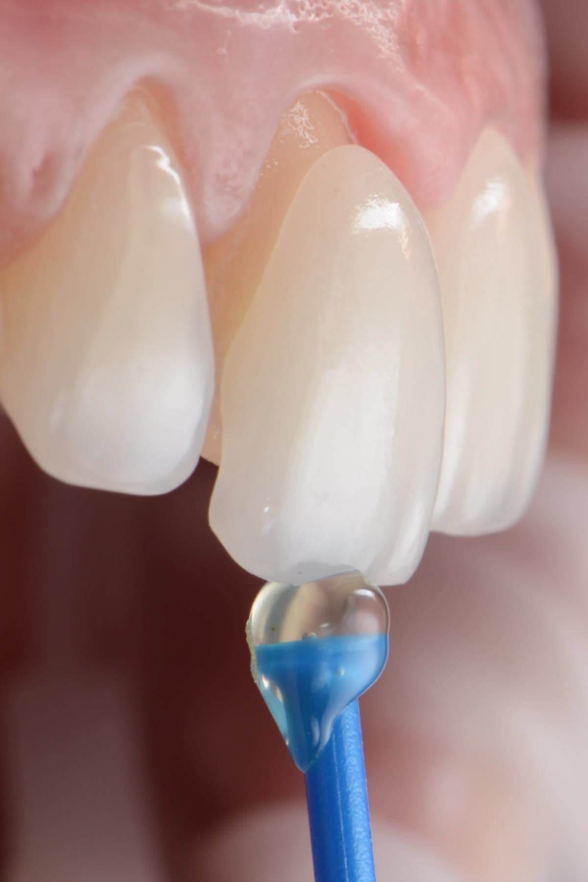 Lente de contato dental sendo aplicada sobre o dente com instrumento de precisão